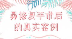 鼻修复手术后的真实案例分享！来看看我的手术体验及恢复过程果吧！