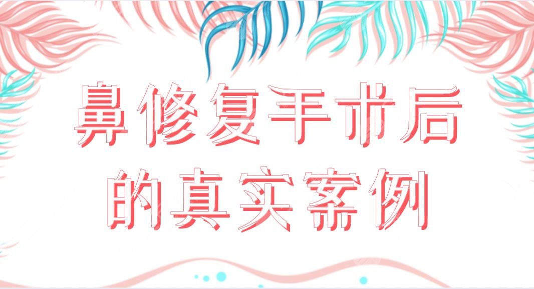 鼻修复手术后的真实案例分享！来看看我的手术体验及恢复过程果吧！