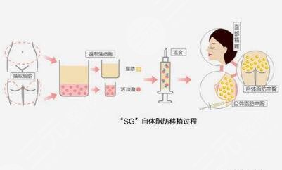 自体脂肪丰胸可以维持多长时间?