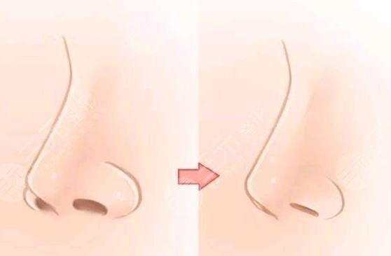 隆鼻1-7天恢复过程图