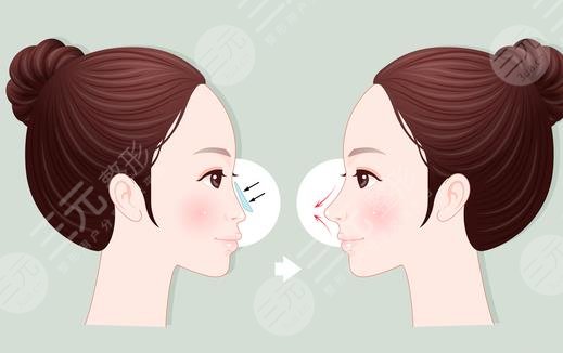 隆鼻1-7天恢复过程图