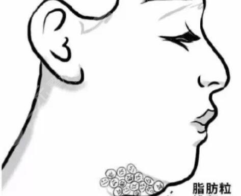 下颌角