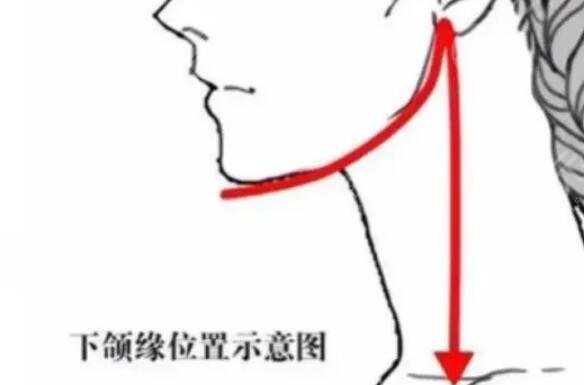 下颌缘吸脂