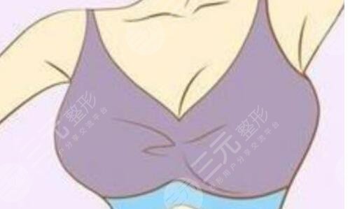 隆胸