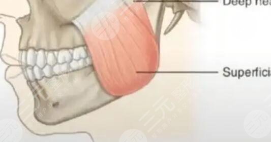 下颌缘整形