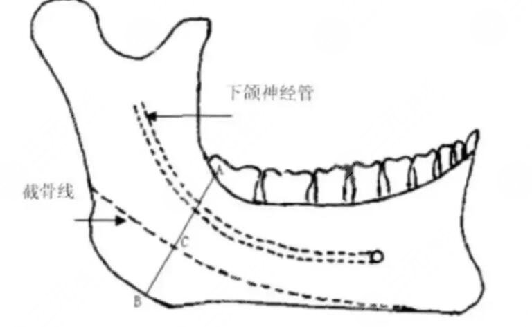 下颌缘吸脂