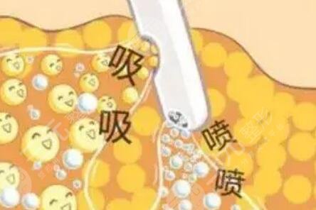 吸脂