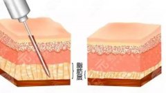 下颌缘紧致提升怎么做的？3种常用方式分享，满分侧颜的打造秘籍！