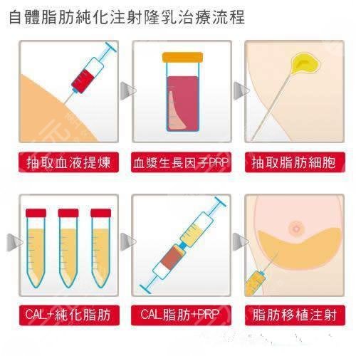 自体脂肪隆胸科普