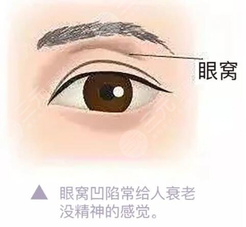 自体脂肪填充眼窝凹陷图片真人展示，果真的算是雪中送炭了，不信你看！