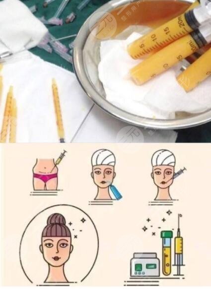 自体脂肪填充有什么果?