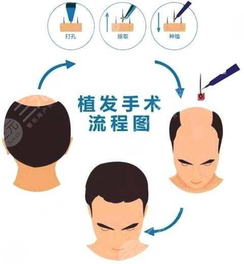 头发种植技术缓解的过程中痛不痛?
