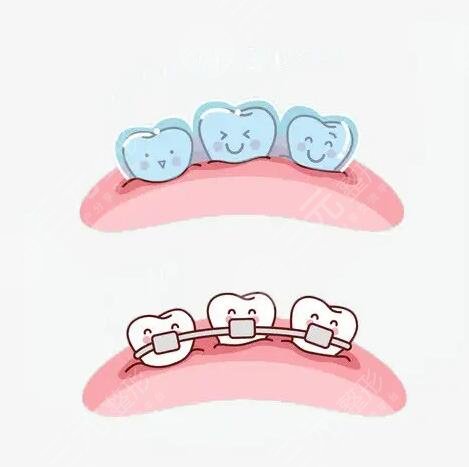 戴牙套价目表一览