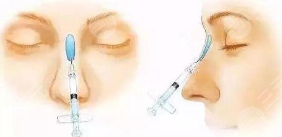 自体脂肪隆鼻
