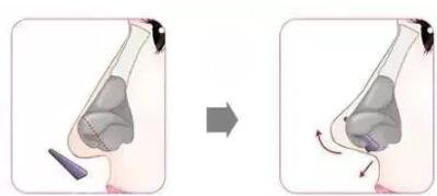 假体隆鼻