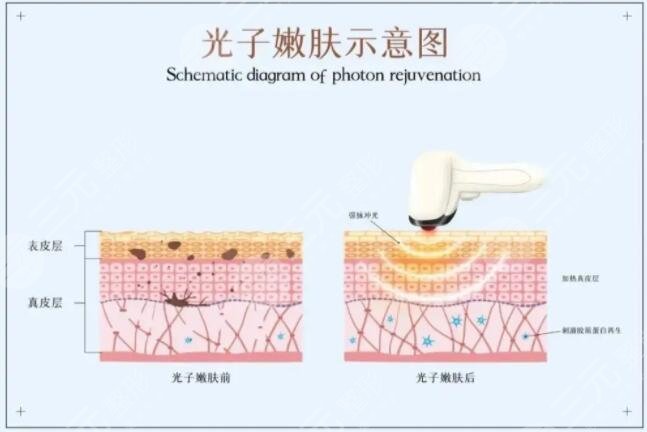 光子嫩肤一般多少钱一疗程？