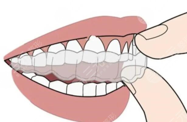 牙科诊所牙齿矫正案例