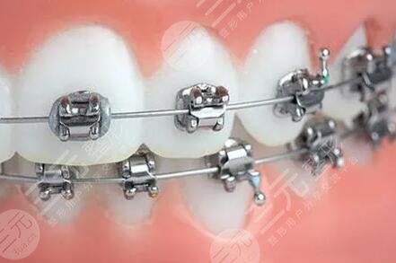 牙科机构的牙齿矫正项目价格