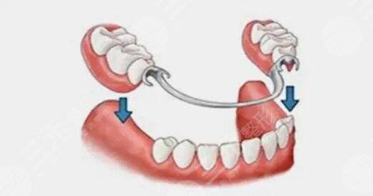 目前镶牙价格表连夜更新！镶牙的方法有几种？牙齿决定了90%的颜值！