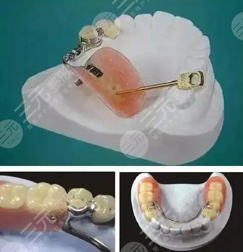 目前镶牙价格表