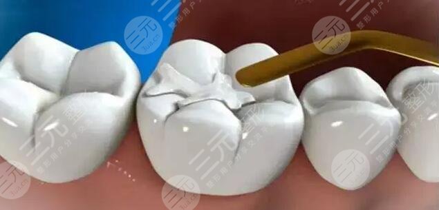 镶牙的方法有几种?