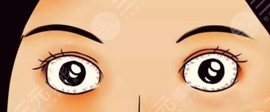 眼球突出整形前后图片,恢复后终于告别"死鱼眼"了,颜值美美哒!