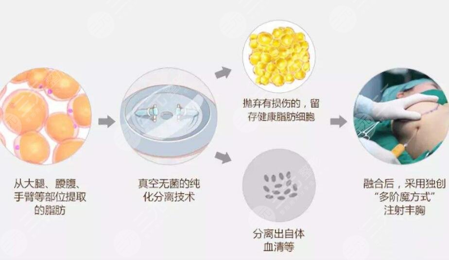 自体脂肪隆胸手术以后