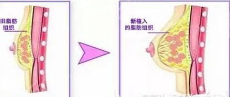 自体脂肪隆胸手术果