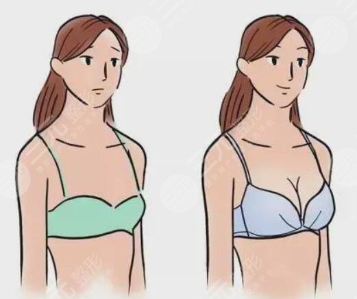 自体脂肪隆胸手术果