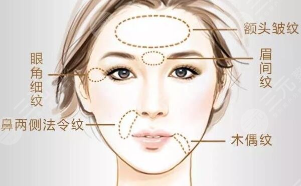 保妥式瘦脸注意事项有哪些
