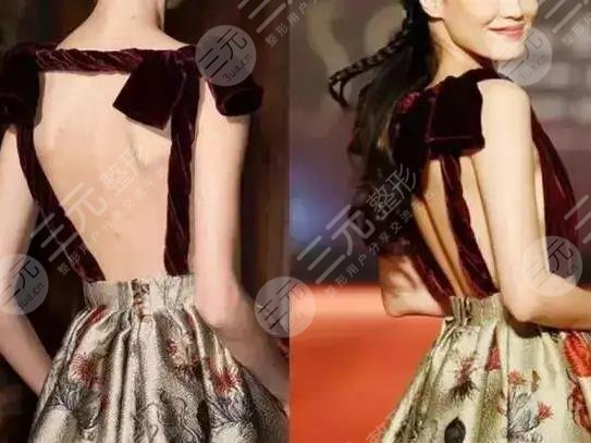 胖的人为什么有脊柱沟?是天生的吗?脊柱沟深好还是不好?