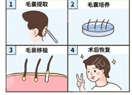 微针植发技术是怎样的?