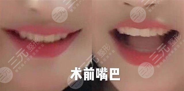 女子整容失败嘴巴歪是真的吗?