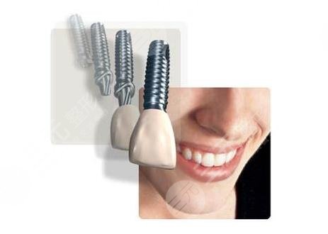 种植牙的过程步骤