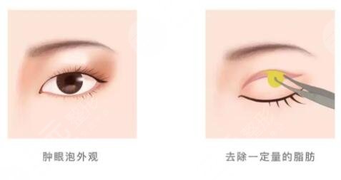 割双眼皮大概要多少钱?