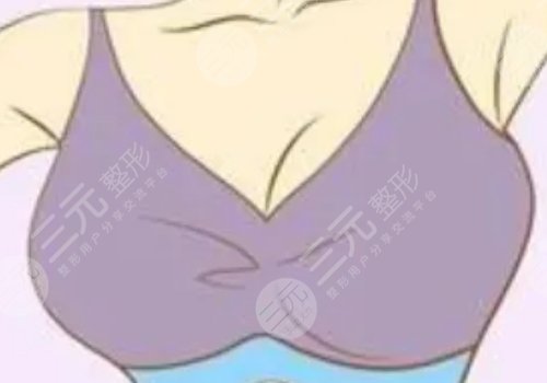 丰胸有哪些注意事项?