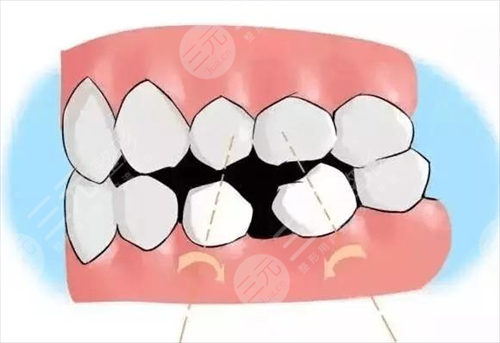 牙缝怎么补？牙缝大可以矫正吗？牙缝大怎么修复好？
