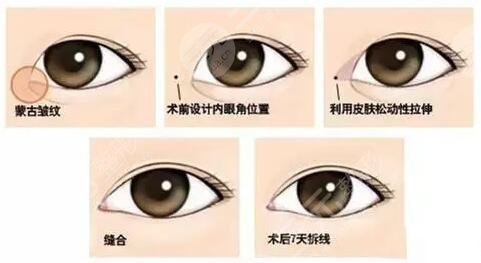 开眼角手术