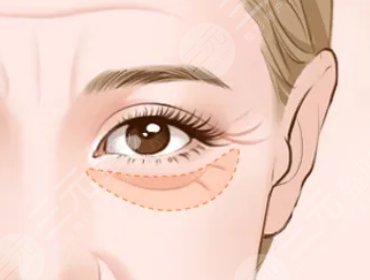 淡化眼部干细纹的妙招有哪些?什么手术可以淡化眼部细纹?