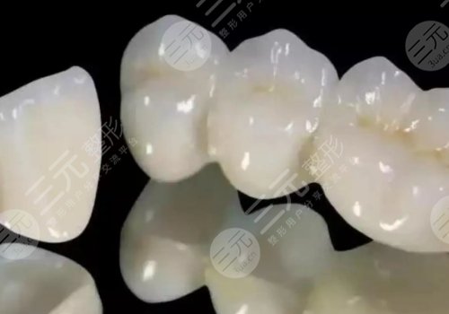 哪种烤瓷牙性价比高?烤瓷牙是什么原理?