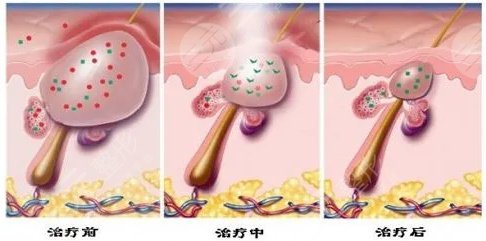 怎么消青春痘?微针祛痘和激光祛痘哪个好?