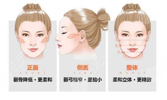 去颊脂垫后遗症|去颊脂垫后遗症有哪些