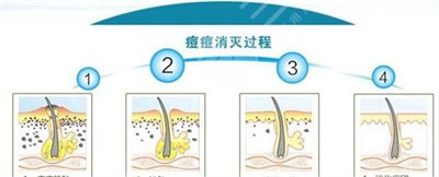 激光去痘疤