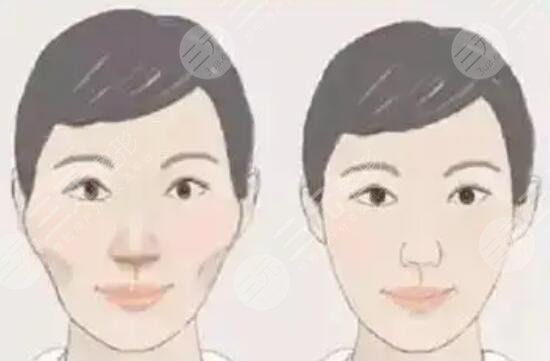 怎样可以让颧骨变低变窄? 怎样可以让颧骨变低变窄?