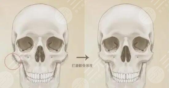 关于磨颧骨手术你应该知道的常识 关于磨颧骨手术你应该知道的常识