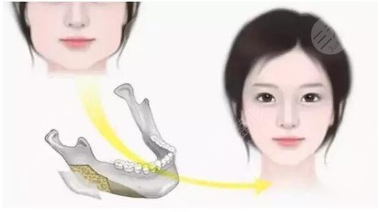 下颌骨歪斜可以矫正吗?怎样矫正? 下颌骨歪斜可以矫正吗?怎样矫正?