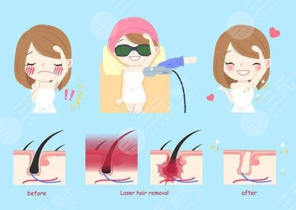 激光脱毛的优势有哪些?