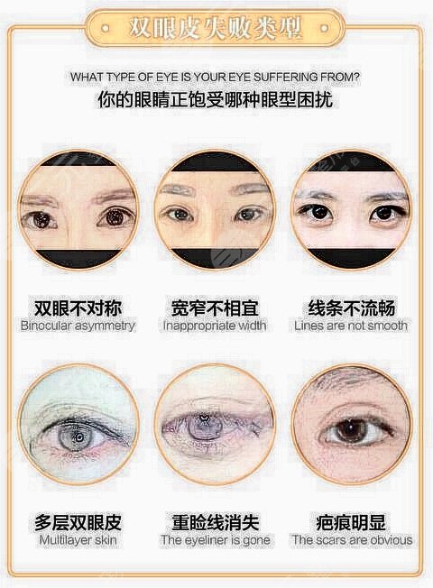 鼻翼鼻尖整形手术的果好不好