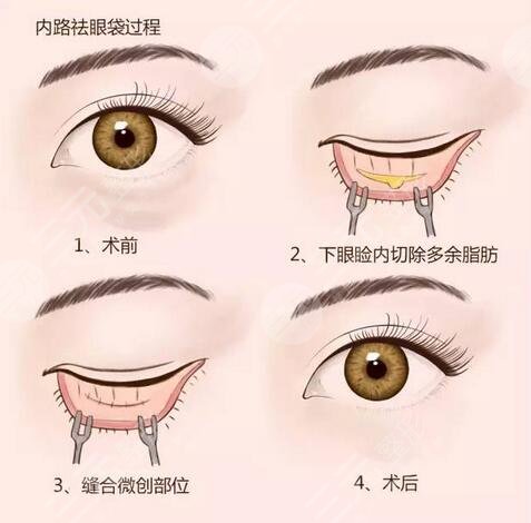 眼袋是怎样形成的 简单有的去眼袋方法有哪些