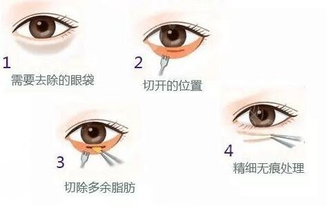 眼袋是怎样形成的 简单有的去眼袋方法有哪些